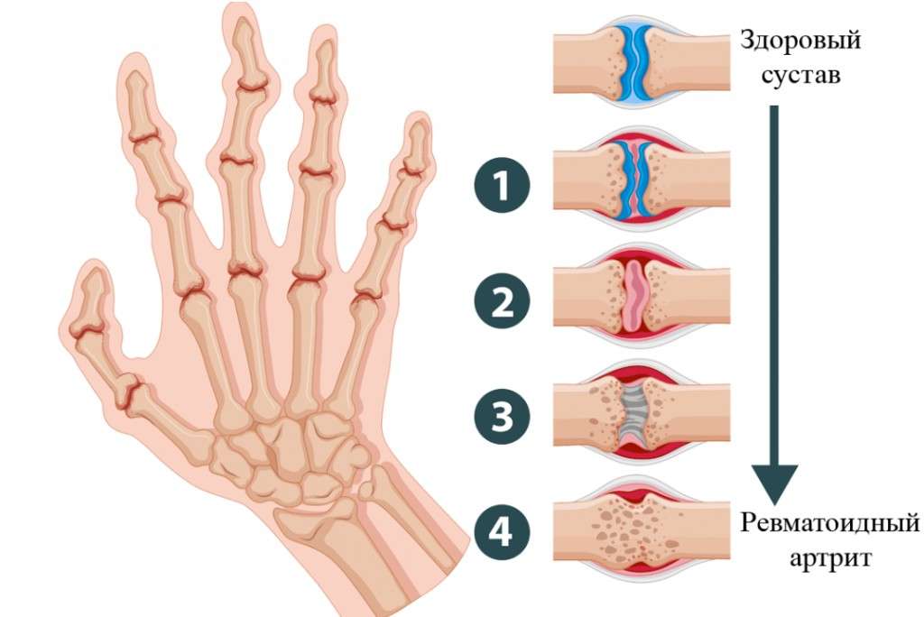 Артрит суставов пальцев рук: симптомы и правильное лечение
