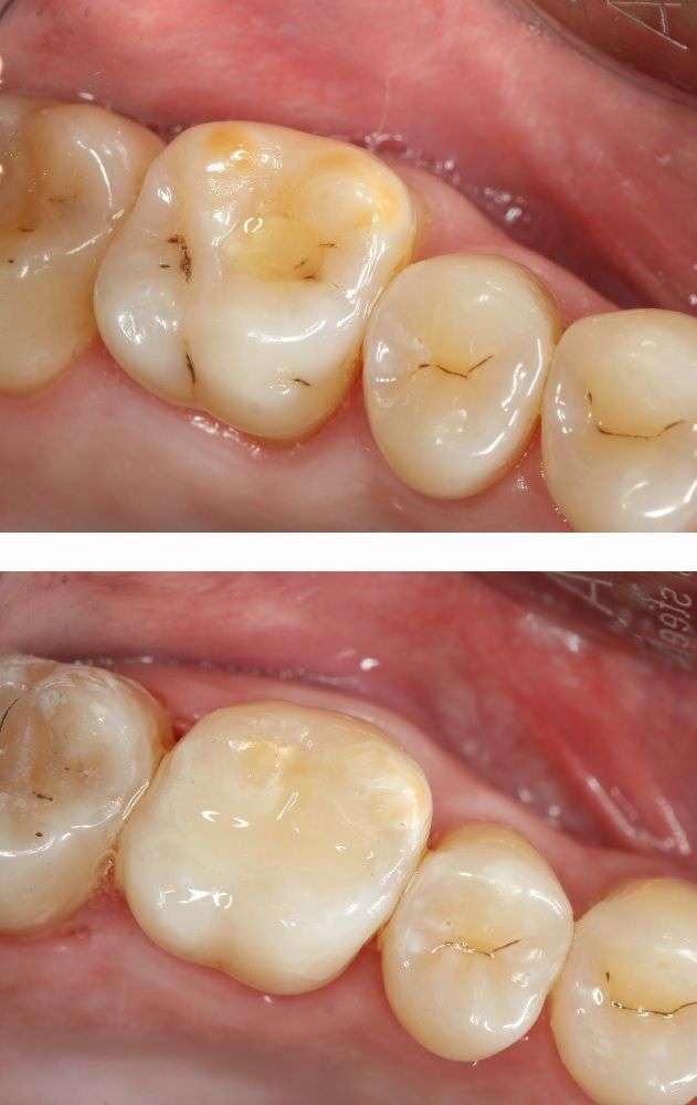Болит зуб после лечения кариеса: что делать