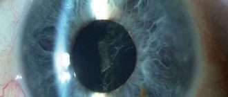 Что такое вторичная катаракта после замены хрусталика: лечение лазером, профилактика