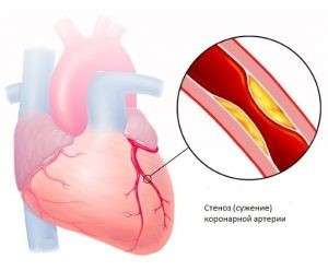 Диабет и сердечно-сосудистые заболевания: почему поражаются сердце и сосуды?