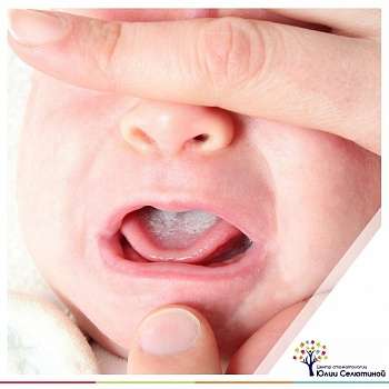 Молочница у новорожденных во рту лечение в домашних условиях зеленкой
