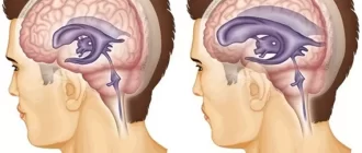 Наружная гидроцефалия головного мозга у взрослого симптомы и лечение