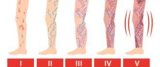 Сосудистые заболевания ног: классификация, симптомы и лечение