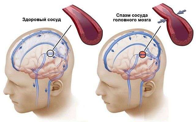 Заболевания сосудов головного мозга